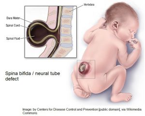 Spina bifida / neural tube defect